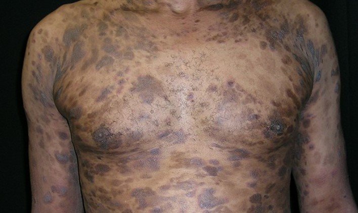 Skin Lymphoma 