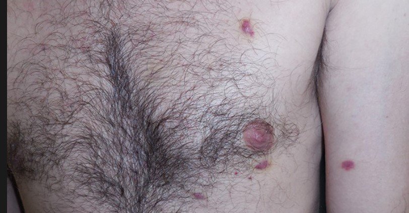 Kaposi Sarcoma 