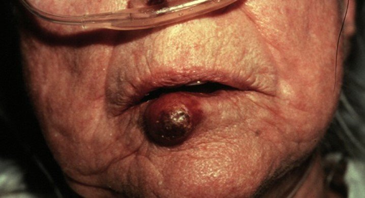 Merkel Cell Carcinoma 